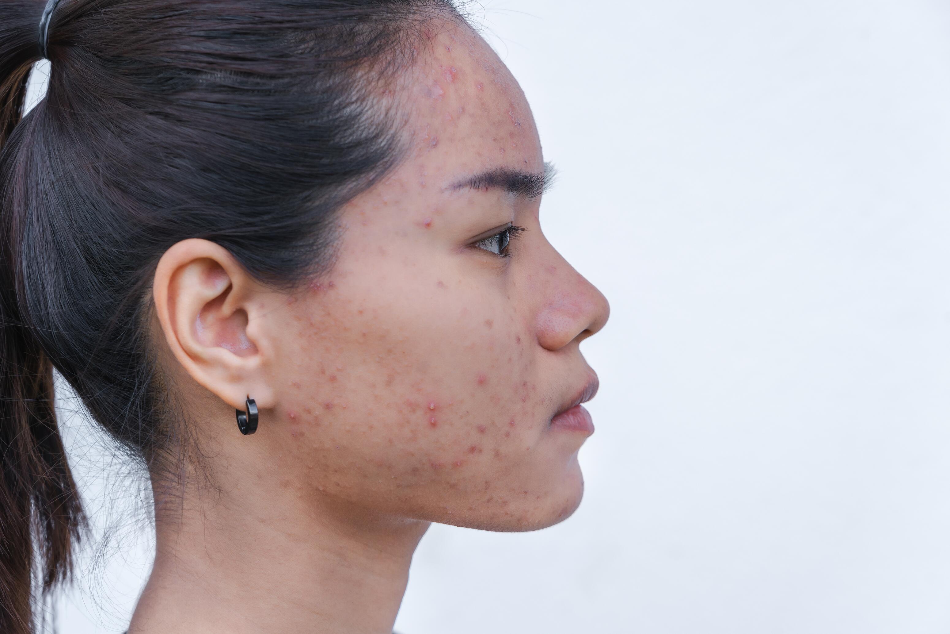 Hormonal acne refers to acne in adult women